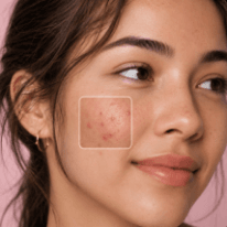 Acne & Blemish