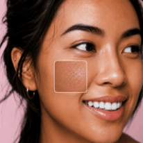 Black Heads