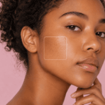 Enlarged Pores